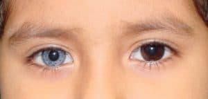 what is heterochromia