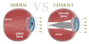 issues caused by cataracts